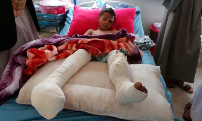 Photo of child in hospital after Yemen airstrike attack