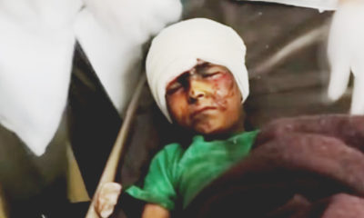 Photo of Yemeni child injured in Saudi-led airstrike