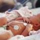 Photo of a premature baby in NICU